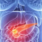 un nou test ar putea depista cancerul pancreatic in stadiile initiale 6851c4fb37279