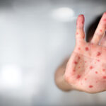 moartea unui copil bolnav de rujeola a starnit un val de conspiratii antivacciniste in marea britanie 687dd9dae9fc4