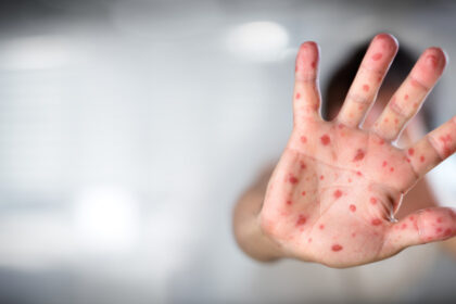 moartea unui copil bolnav de rujeola a starnit un val de conspiratii antivacciniste in marea britanie 687dd9dae9fc4