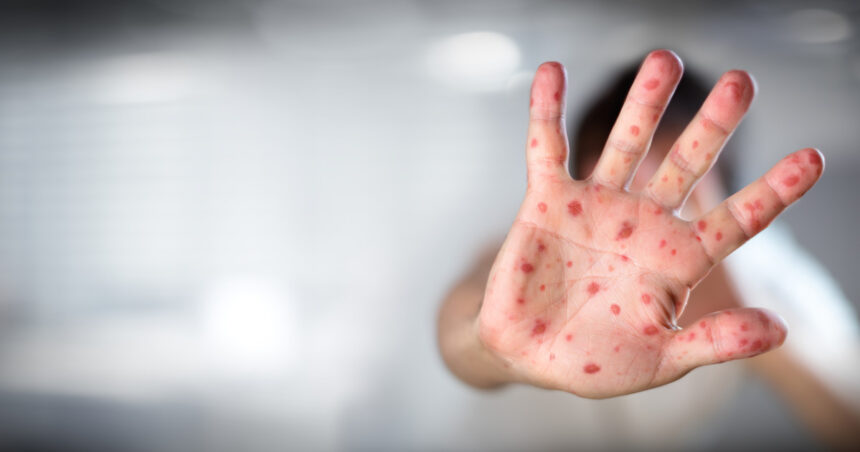 moartea unui copil bolnav de rujeola a starnit un val de conspiratii antivacciniste in marea britanie 687dd9dae9fc4