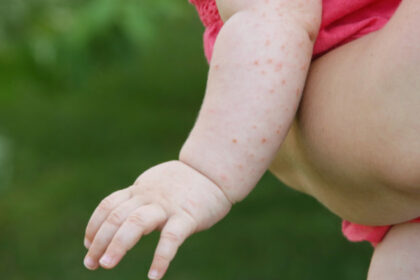 sua se confrunta cu cea mai grava epidemie de rujeola din secolul xxi secretarul de stat robert kennedy jr acuzat ca o alimenteaza 686c1645f06f9