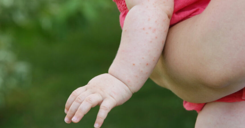 sua se confrunta cu cea mai grava epidemie de rujeola din secolul xxi secretarul de stat robert kennedy jr acuzat ca o alimenteaza 686c1645f06f9