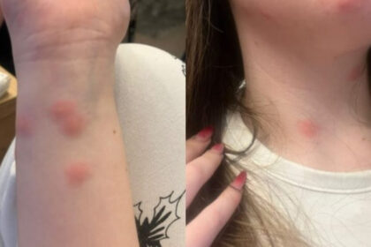 video o tanara a ajuns la spital dupa ce a fost muscata de plosnite intr un tren cfr familia a facut plangere 6922d1f3509ef