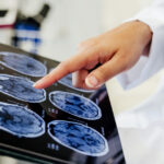 video premiera medicala la spitalul bagdasar arseni din bucuresti operatie pe creier cu pacientul treaz a fost foarte curajos 691c21a65de2b