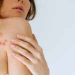 cum recunosti muscatura de plosnita medicii explica riscurile pentru sanatate poate declansa reactii alergice puternice 6933eace7b2c1