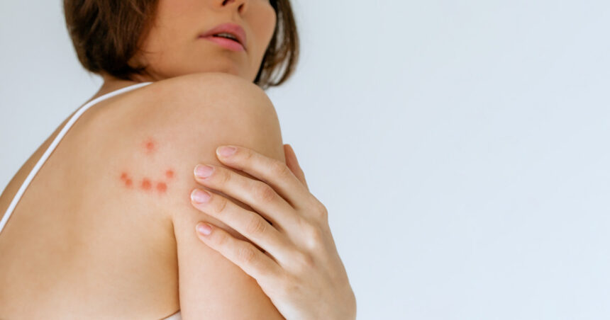 cum recunosti muscatura de plosnita medicii explica riscurile pentru sanatate poate declansa reactii alergice puternice 6933eace7b2c1