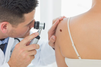 cum identifici alunitele cu risc de cancer dermatologii explica semnele importante care necesita evaluare urgenta 697480ab5e2d0