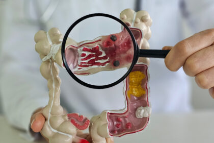 metoda prin care specialistii vor sa descopere de ce tot mai multi tineri sunt diagnosticati cu cancer o resursa unica 69632f79c0553