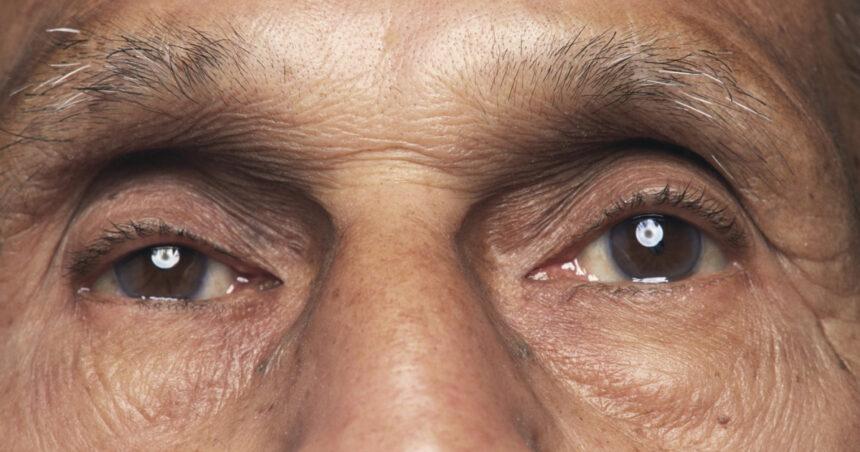 o bacterie prezenta in ochi asociata cu boala alzheimer si declinul cognitiv arata un nou studiu 69879e6b260ab